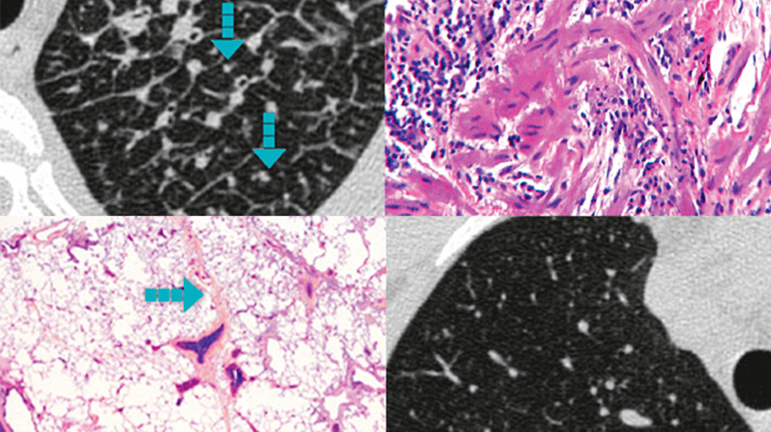 Hrct Patterns In Ild