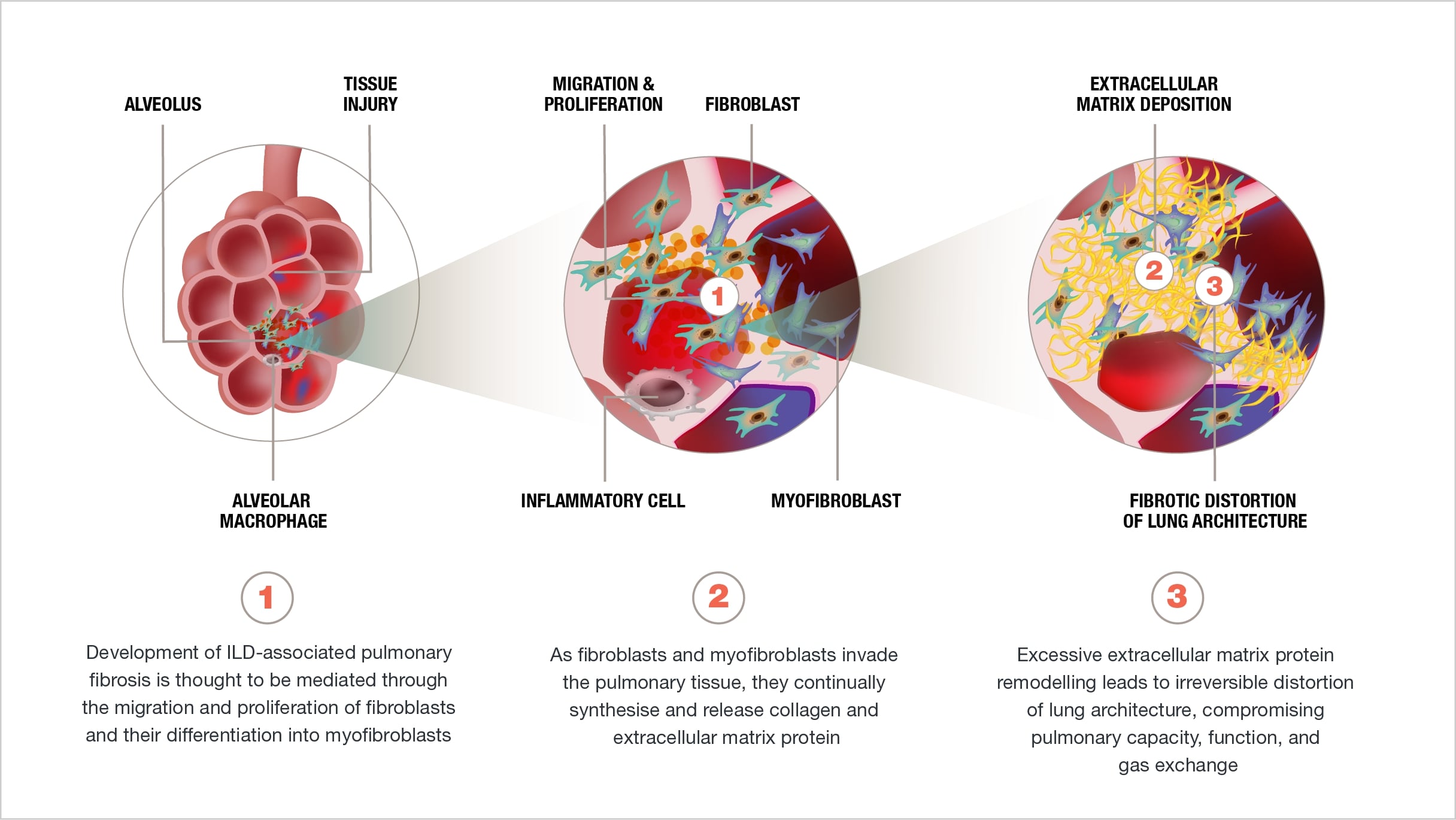 Pathogenic pathways of fibrogenesis in ILDs