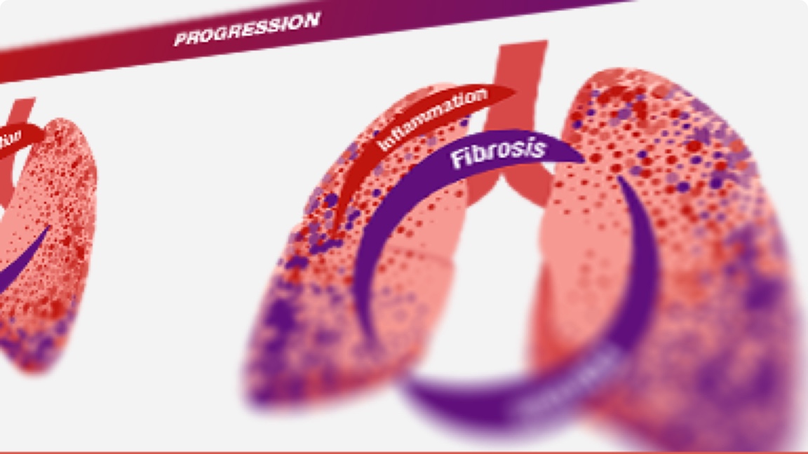 Progressive Fibrosing Phenotype 1770