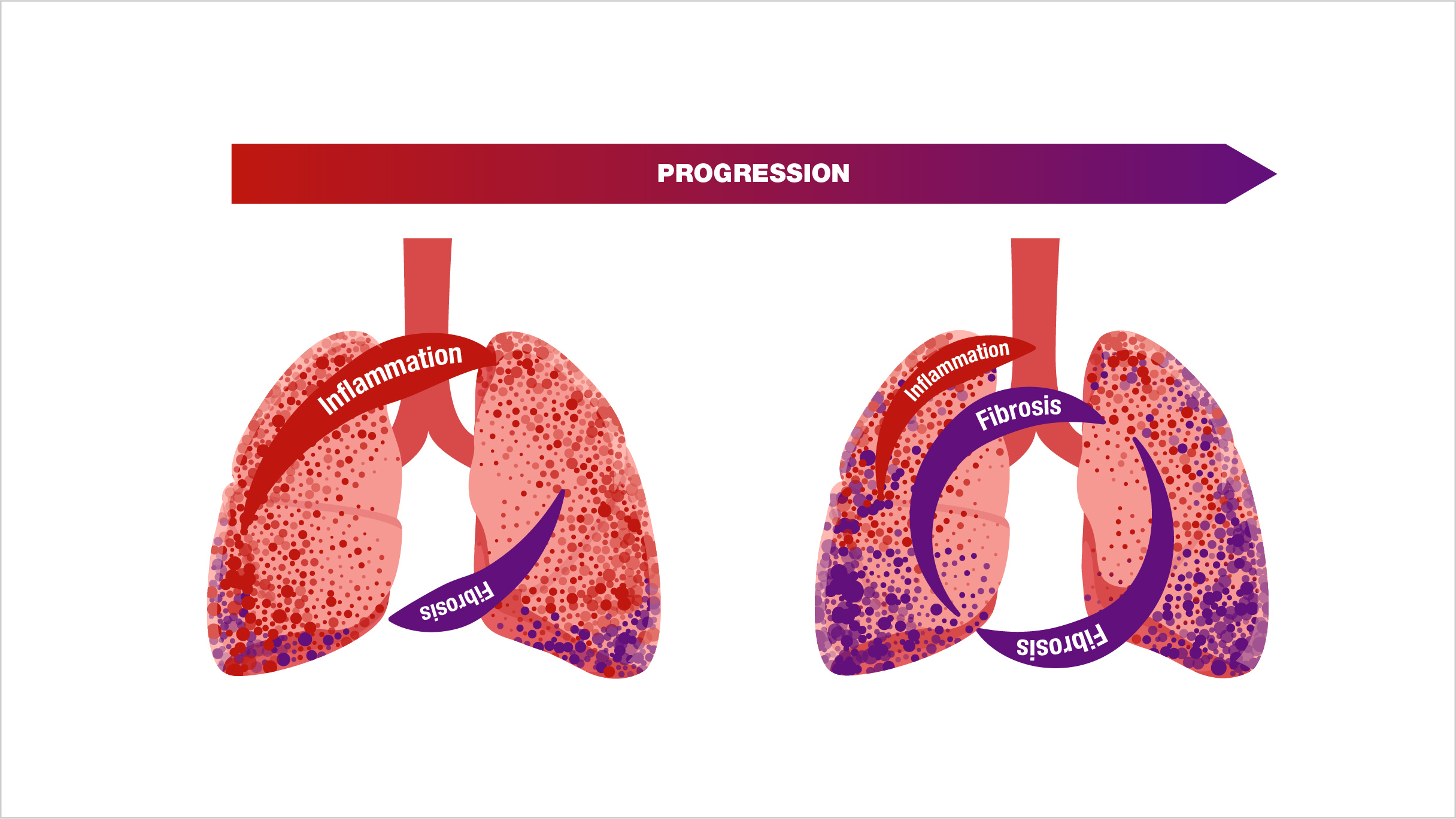 Nature Of Ctd Ilds Progression Pulmonary Fibrosis