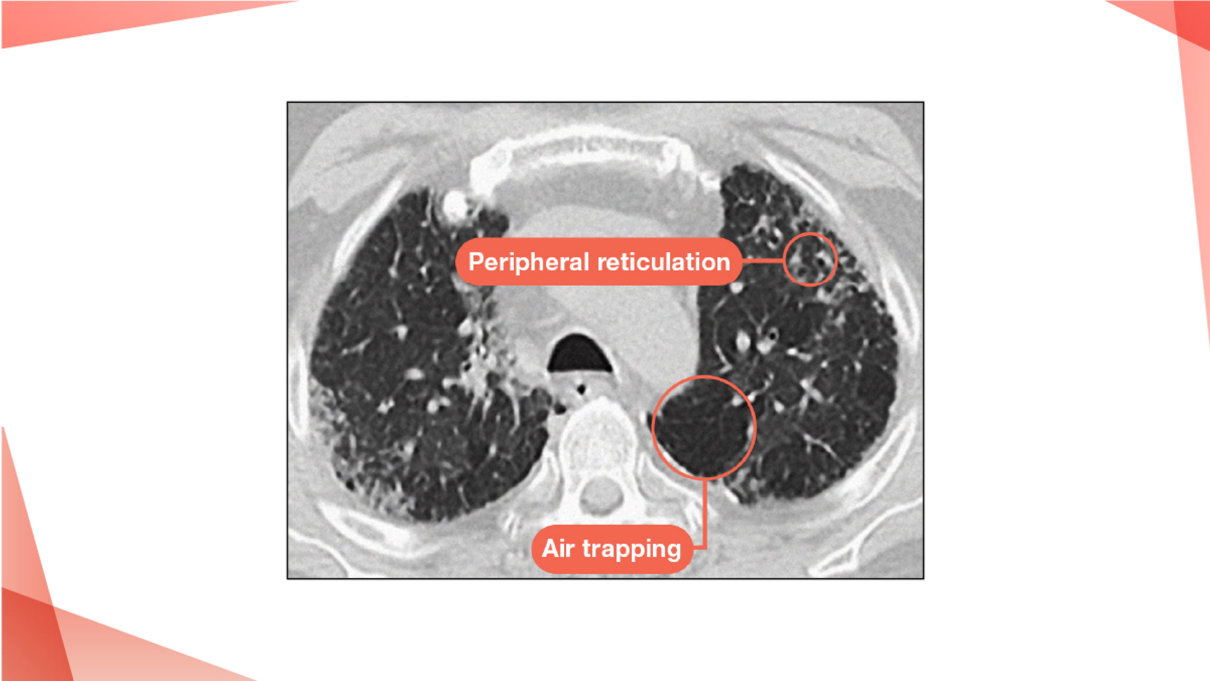 Different Fibrotic ILDs | PulmonaryFibrosis360.com