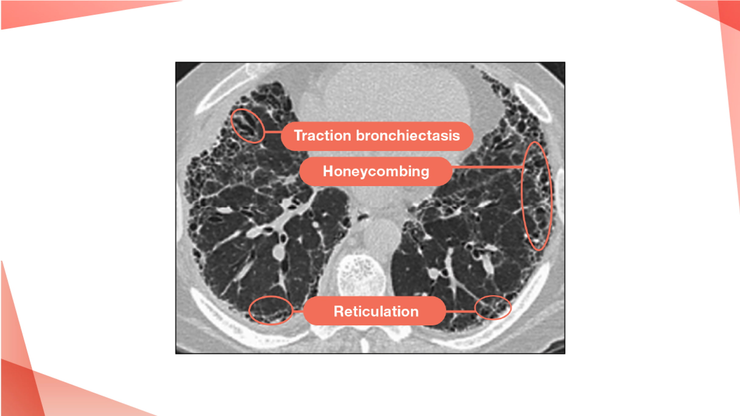 Different Fibrotic ILDs | PulmonaryFibrosis360.com