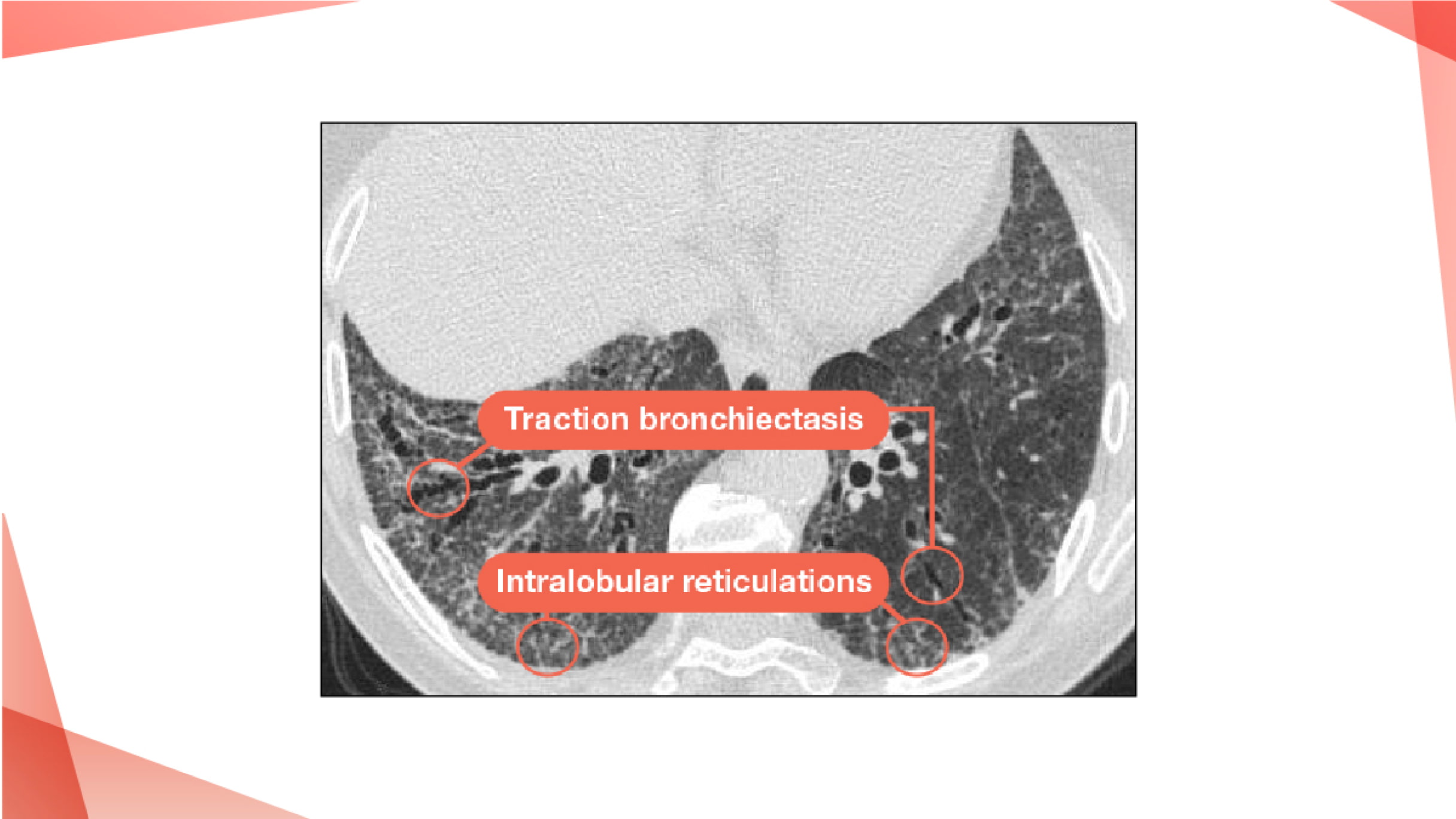 Different Fibrotic ILDs | PulmonaryFibrosis360.com