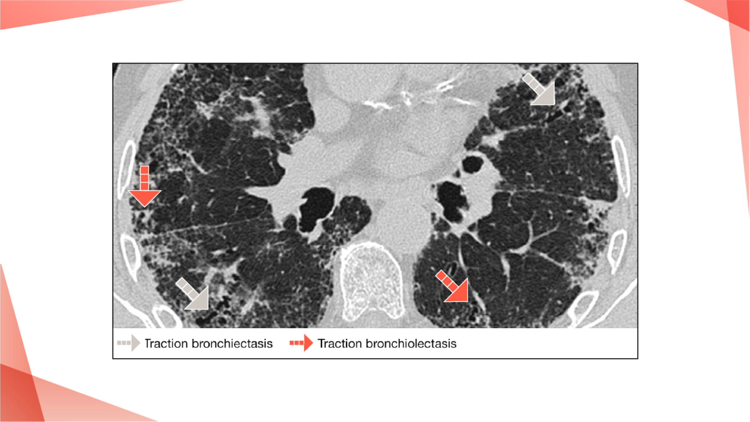 Recognize Fibrotic ILD On HRCT | PulmonaryFibrosis360.com