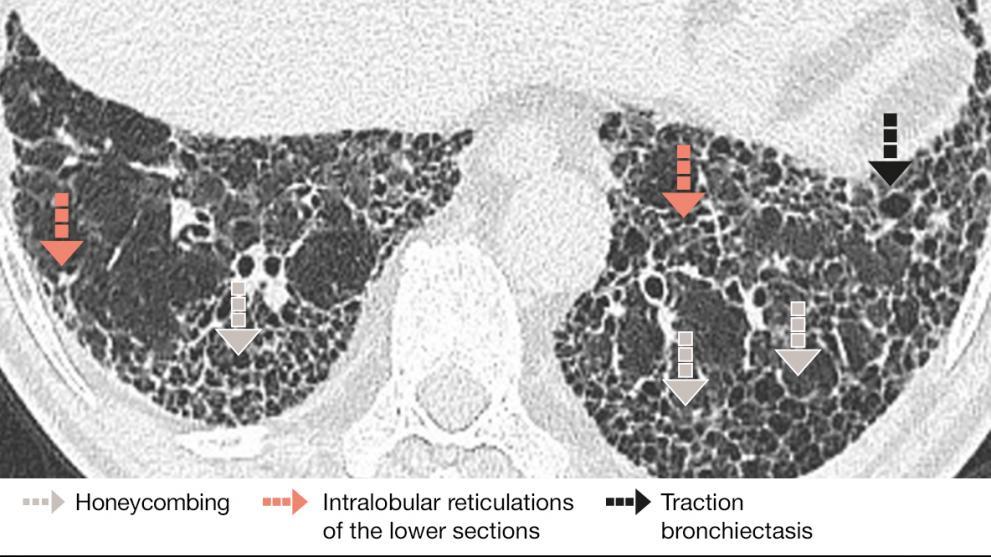 Example of ILD Honeycombing in HRCT