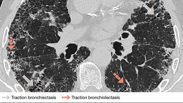Traction bronchiec bronchiol scan